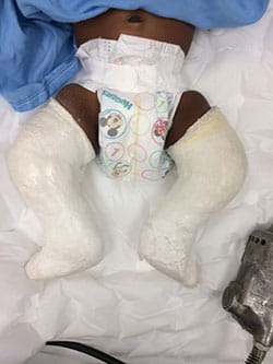 Children S Orthopaedics About Clubfoot Musc Health Charleston Sc
