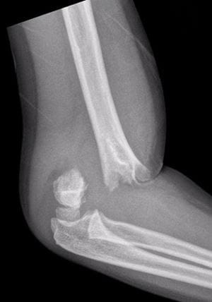X-ray scan image of bone fracture