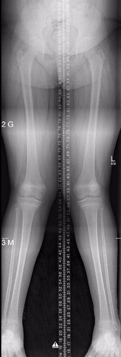 Xray scan of patient with knock knees (genu valgum).