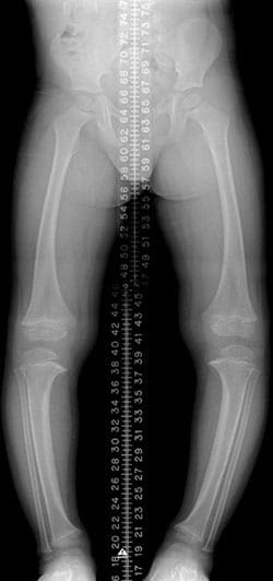 Xray scan of patient with bowed legs (genu varum).