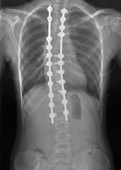 Xray scan of patient post scoliosis treatment