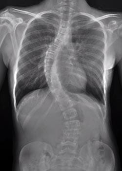 Xray scan of patient with scoliosis pre-treatment