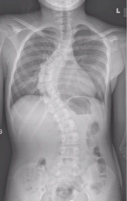 Xray scan of patient with scoliosis.