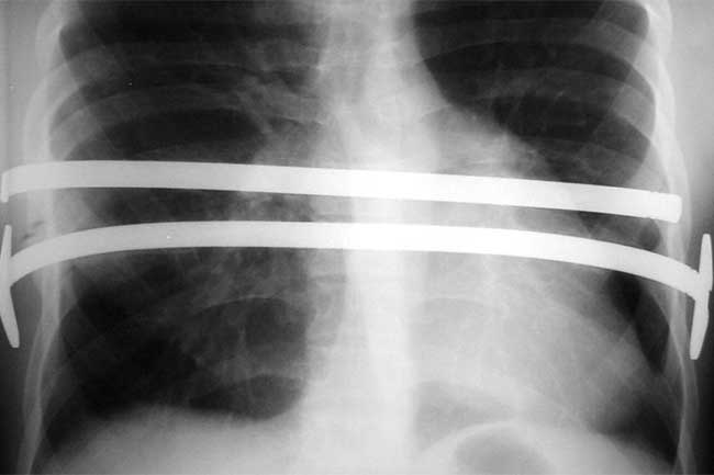 xray of chest with chest bars