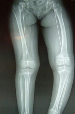 X-ray showing example of early-onset Blount's disease with unilateral out bowing of knee.