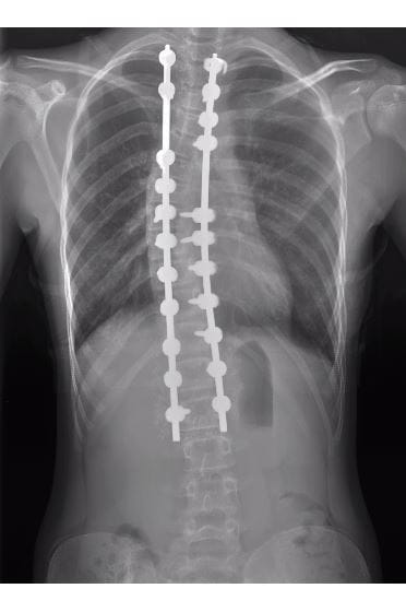 An x-ray showing a straightened spine with rods and screws inserted