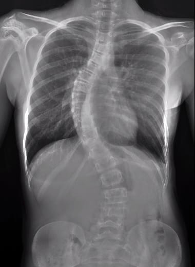 An x-ray showing a spine making an S-curve sideways