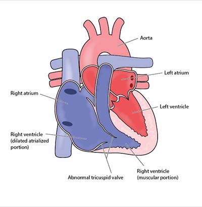 picture of a heart with Ebstein's anomaly. The colors are pink, light purple, purple and red. The illustration shows the aorta, left atrium, left ventricle, right ventricle, abnormal tricuspid valve, right ventricle and right atrium.