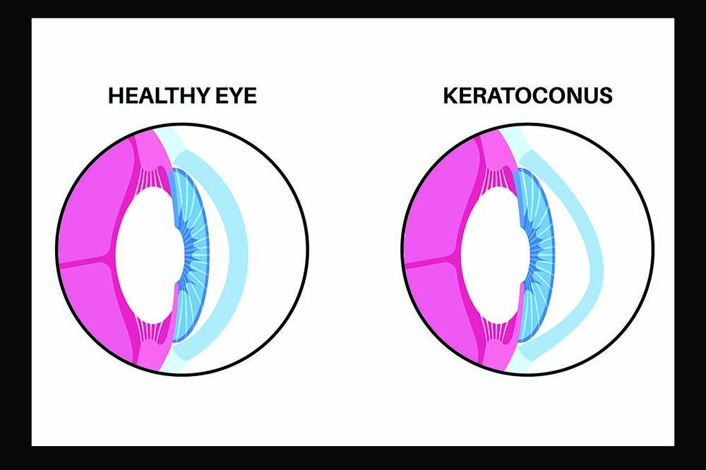 Image on left shows a healthy cornea. On the right is one that has become cone-shaped.
